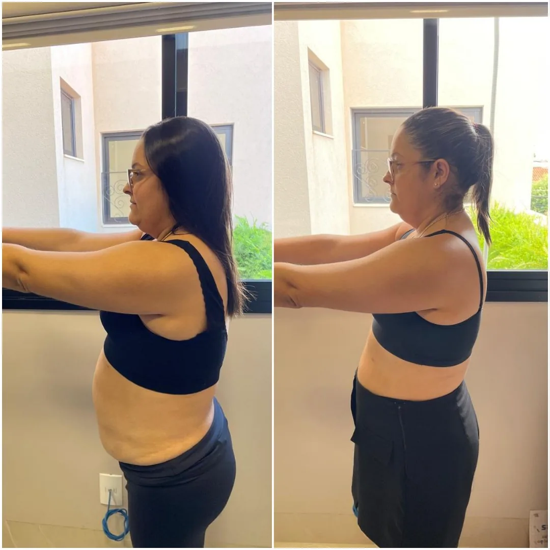 Antes e depois de perfil mostrando redução de abdômen e cintura